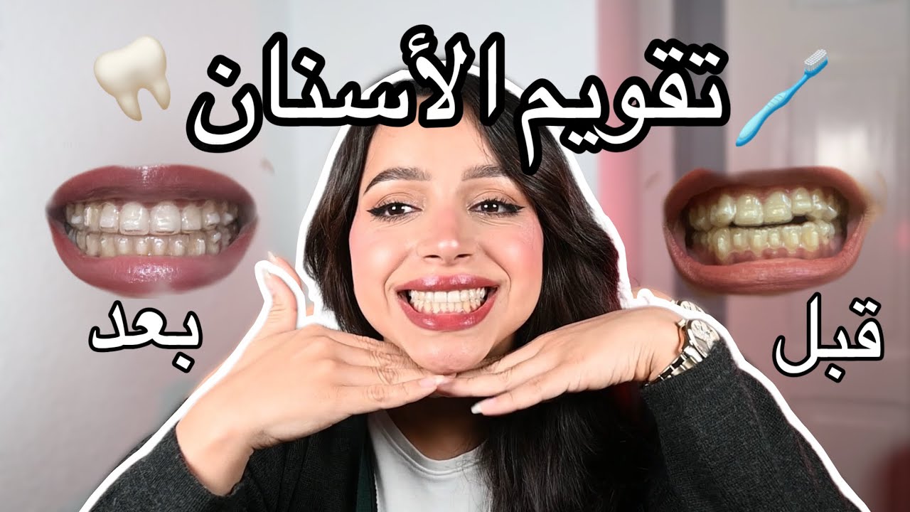 تجربتي مع تقويم الأسنان الشفاف Invisalign 😬🦷 الثمن، المدة، النتيجة..
