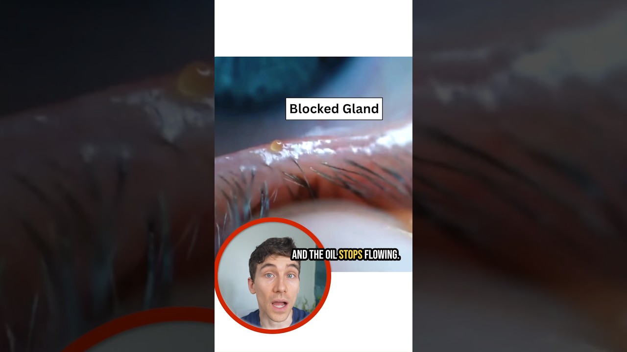 Your Blocked Oil Glands Are Causing Dry Eye