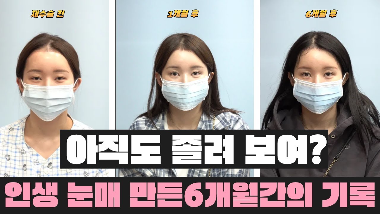 쌍수 직후부터 6개월까지! 졸리고 비대칭 눈이 둥글고 시원해지는 과정#쌍꺼풀재수술