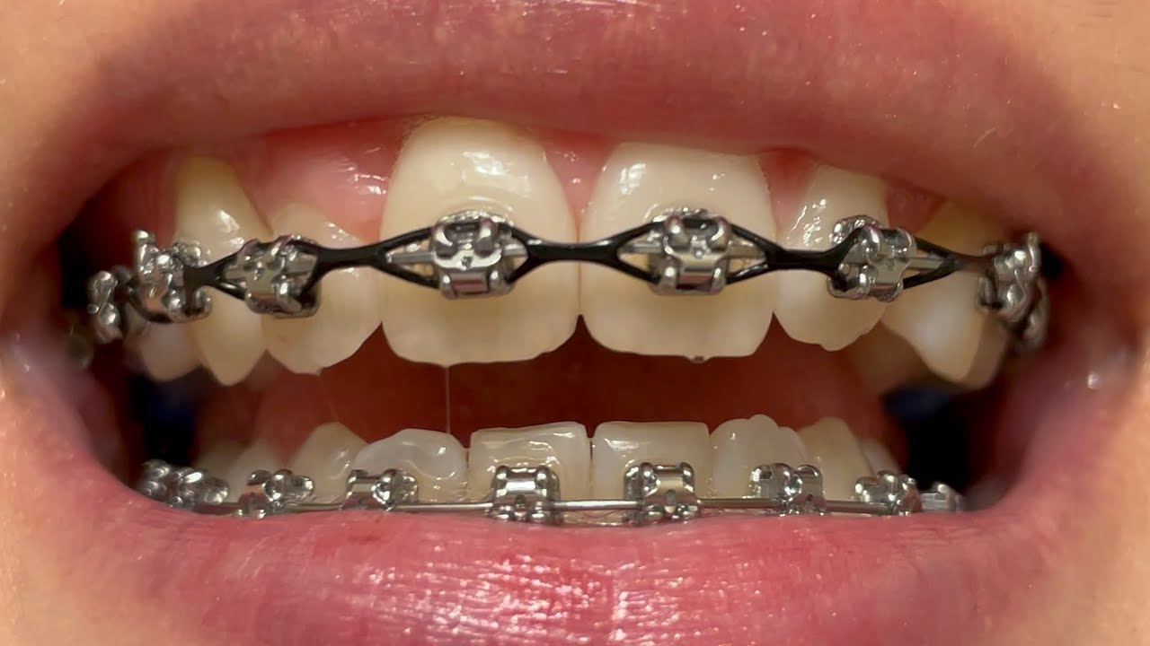 Adult Braces - 20 Month Update!