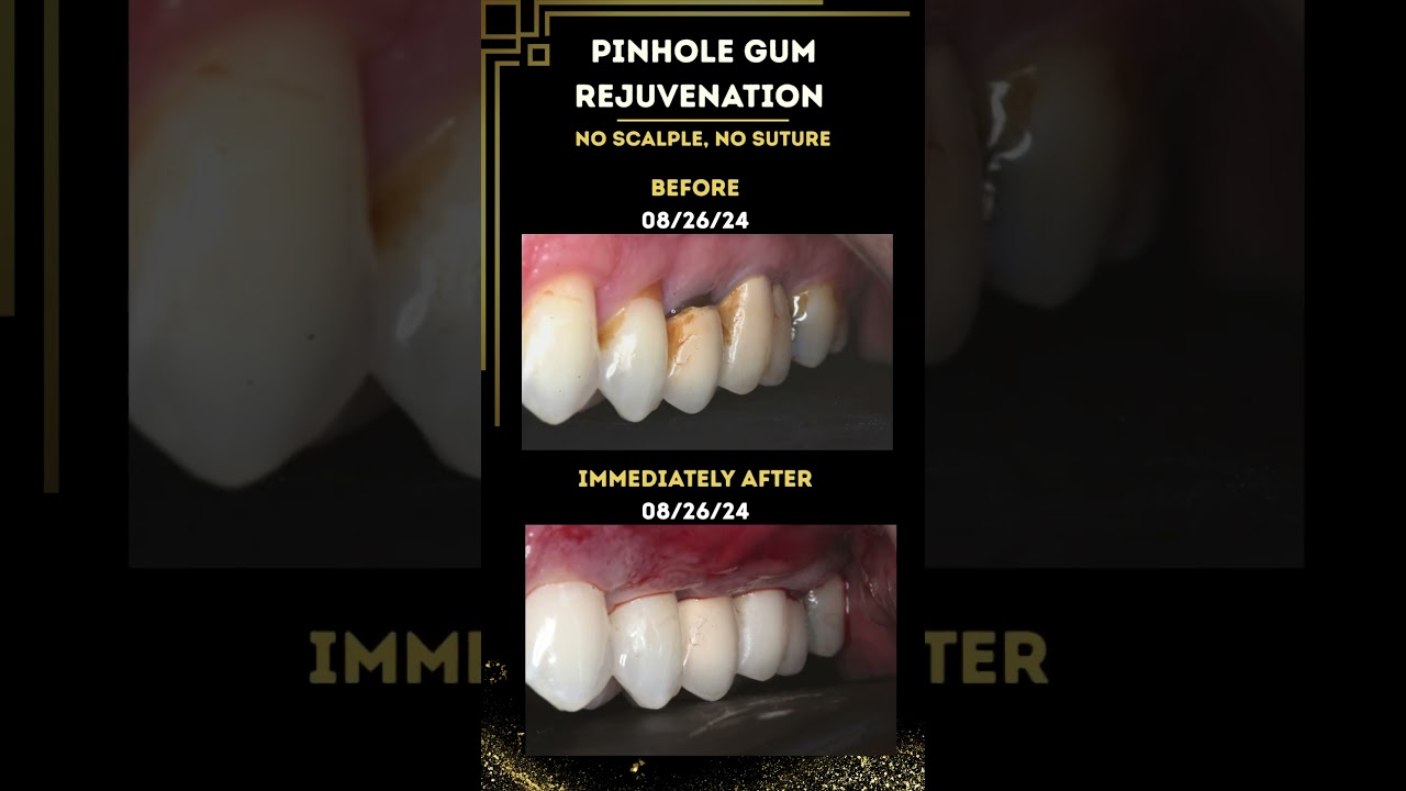 ✨Instant Results &mdash; Immediately After Pinhole&reg; Surgical Technique!