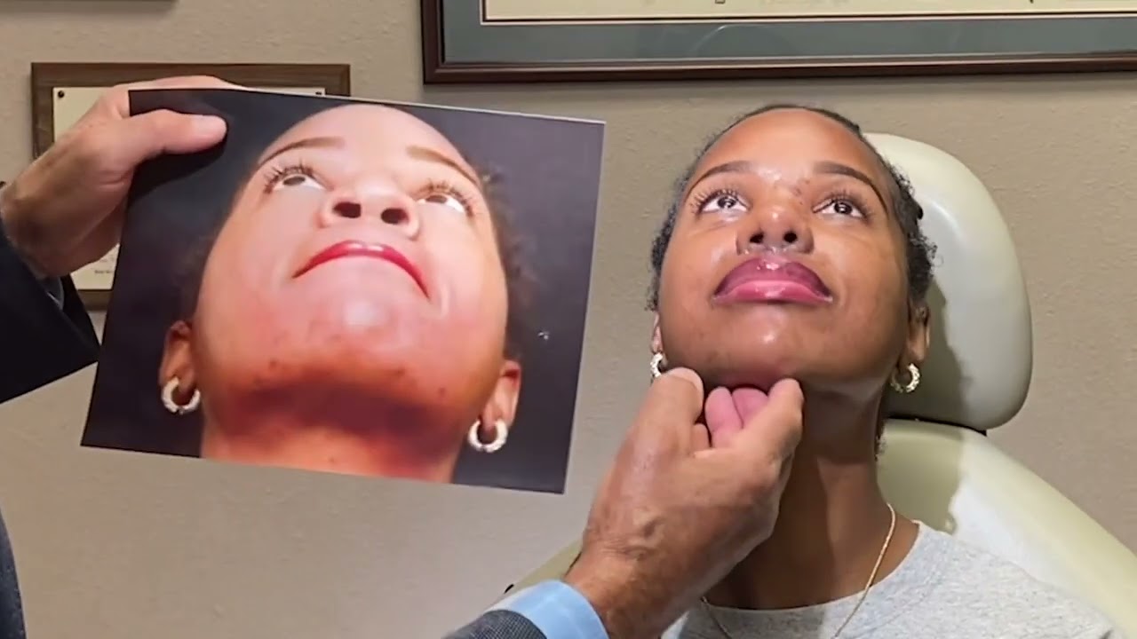 African American Rhinoplasty Cast Reveal