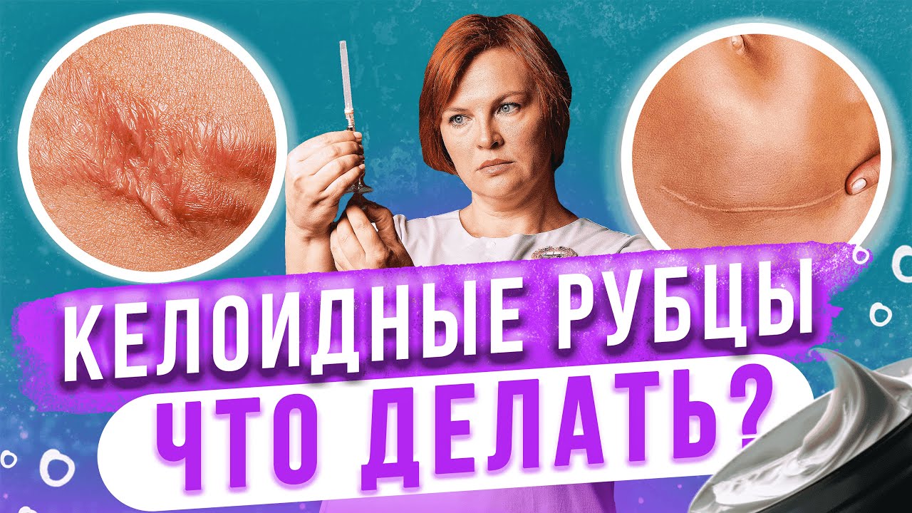Келоидные рубцы. Что точно не стоит делать?