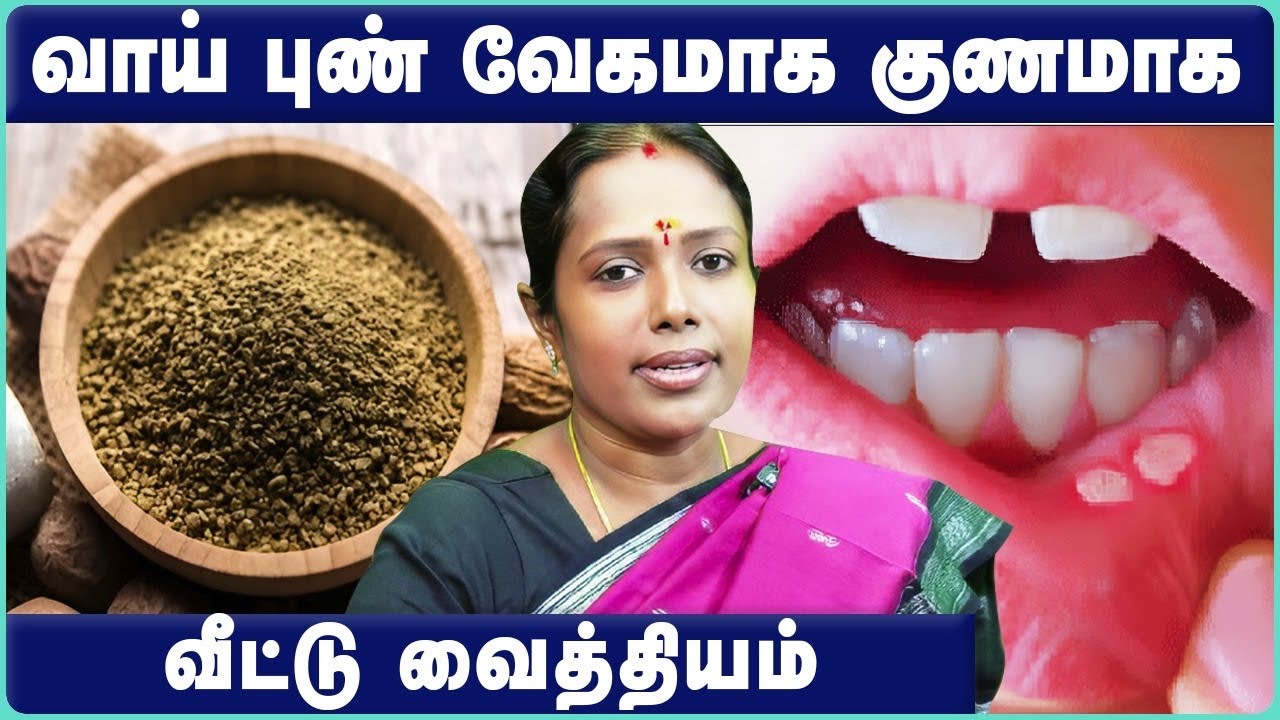 வாய் புண் வேகமாக குணமாக டிப்ஸ்|Quick remedy for Mouth Ulcer|How to cure mouth ulcer fast|Health Tips