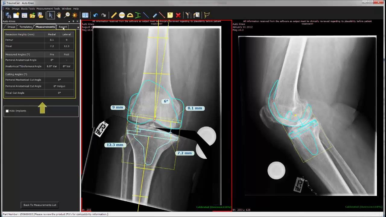 Auto-Knee Planning with TraumaCad