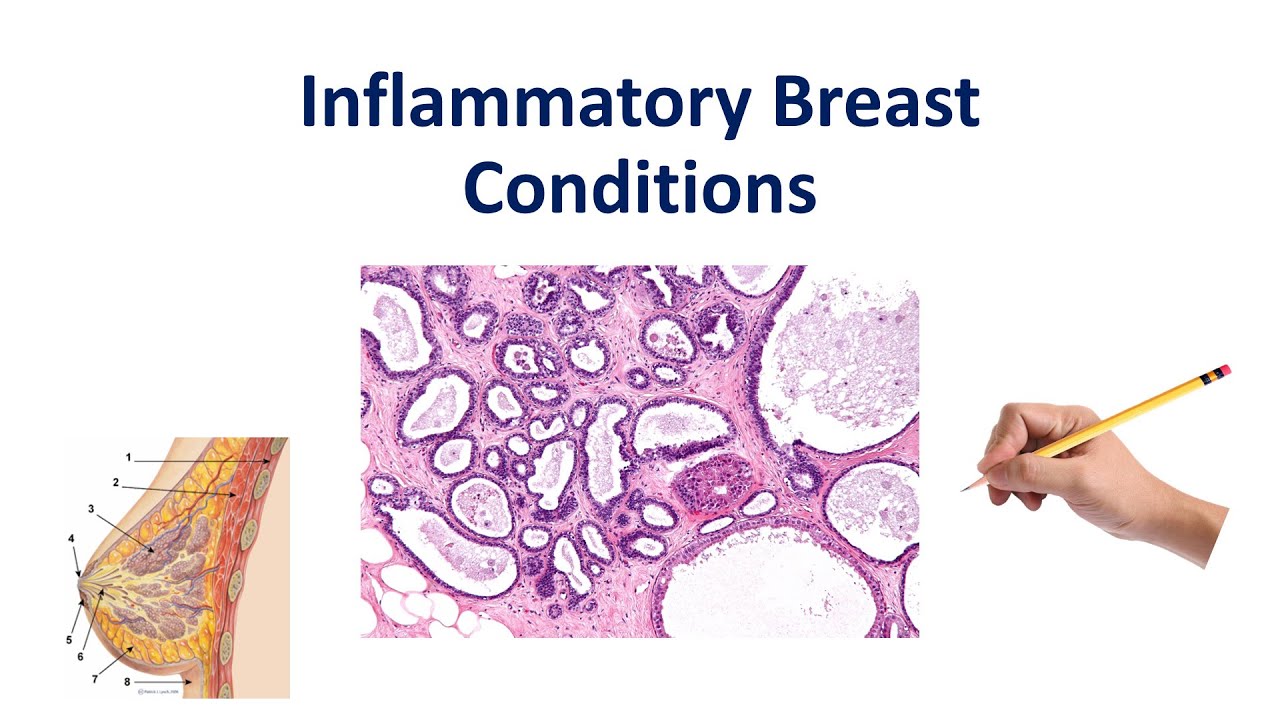 Inflammatory Breast Conditions