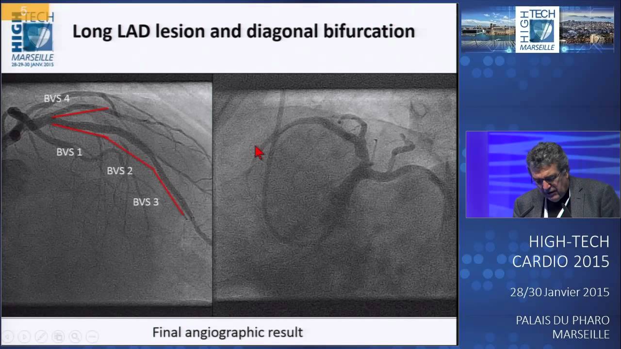Stents biorésorbables : Choisir les indications