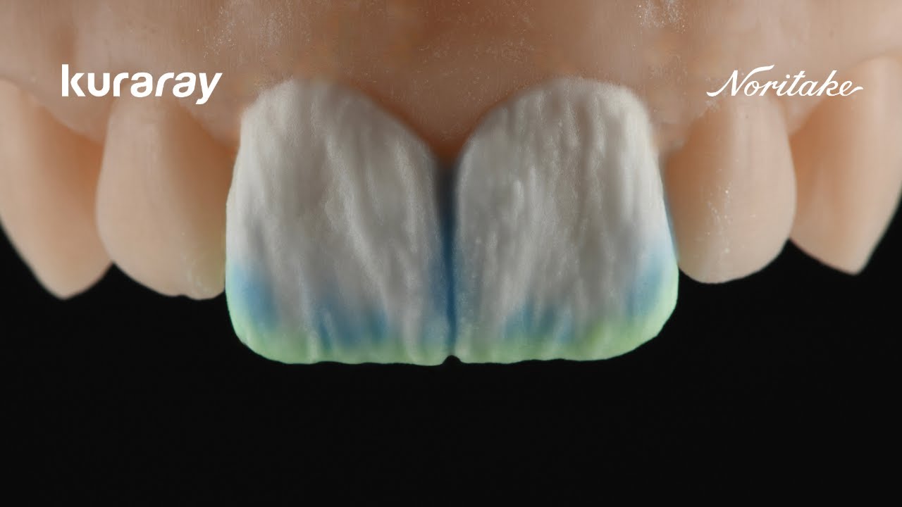 How to Create BL2 Veneers | Micro-Layering with CERABIEN MiLai