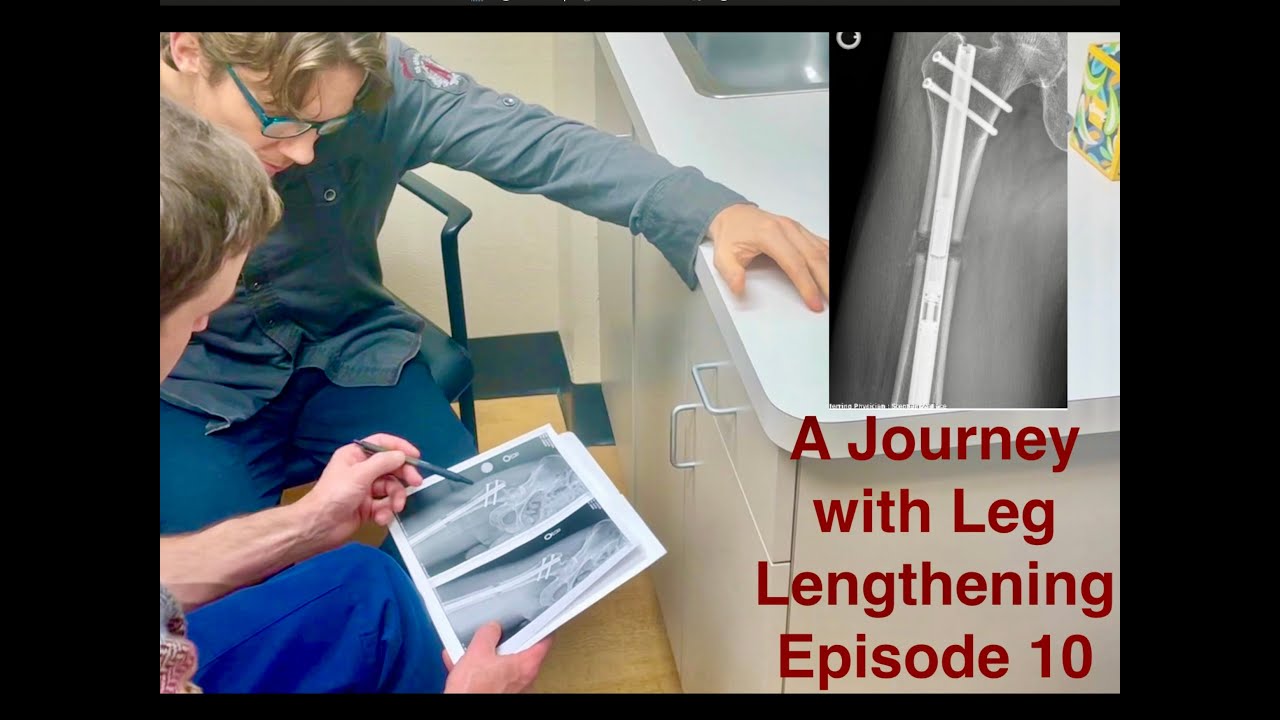 A Journey with Leg Lengthening - Episode 10 - First Follow Up