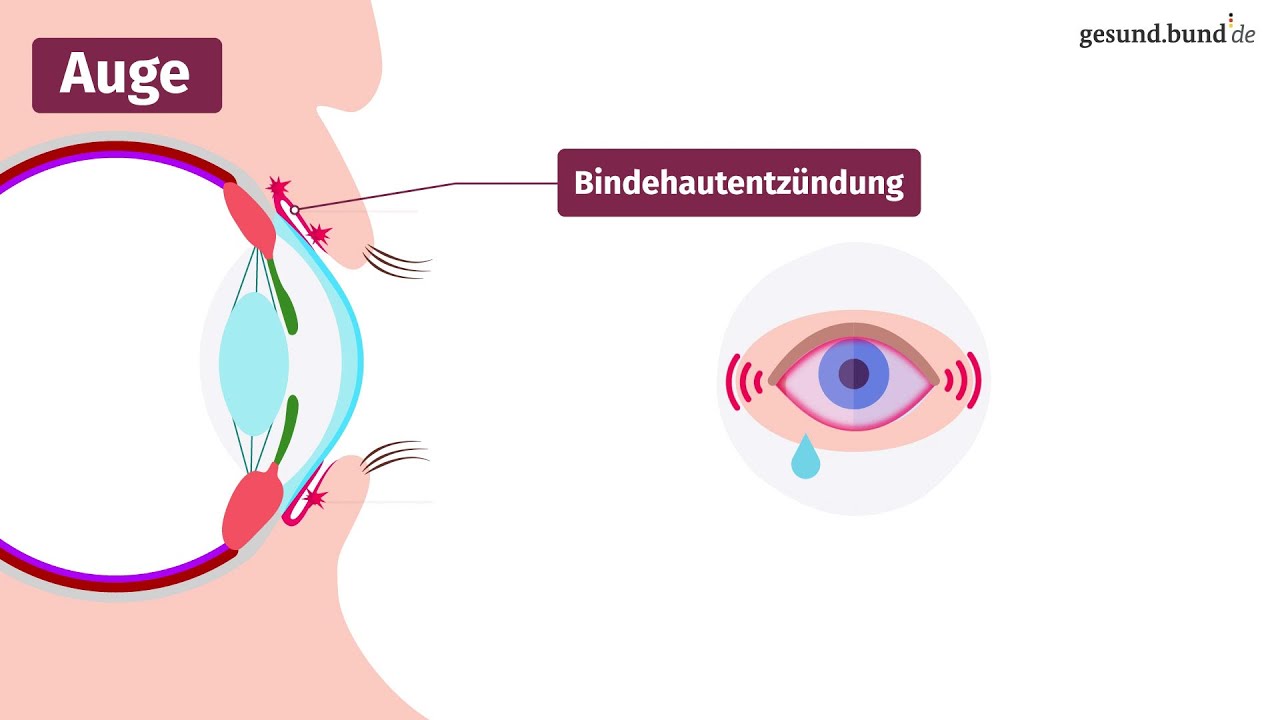 Was ist eine Bindehautentzündung?