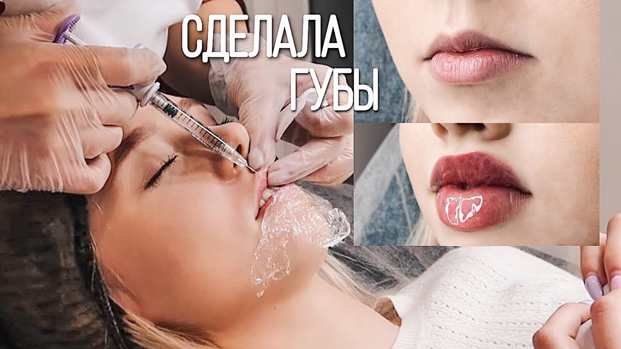 Я УВЕЛИЧИЛА ГУБЫ 😨 Реакция СВЕКРОВИ, ПАРНЯ и БАБУШКИ 🤬 Мой опыт 🔥