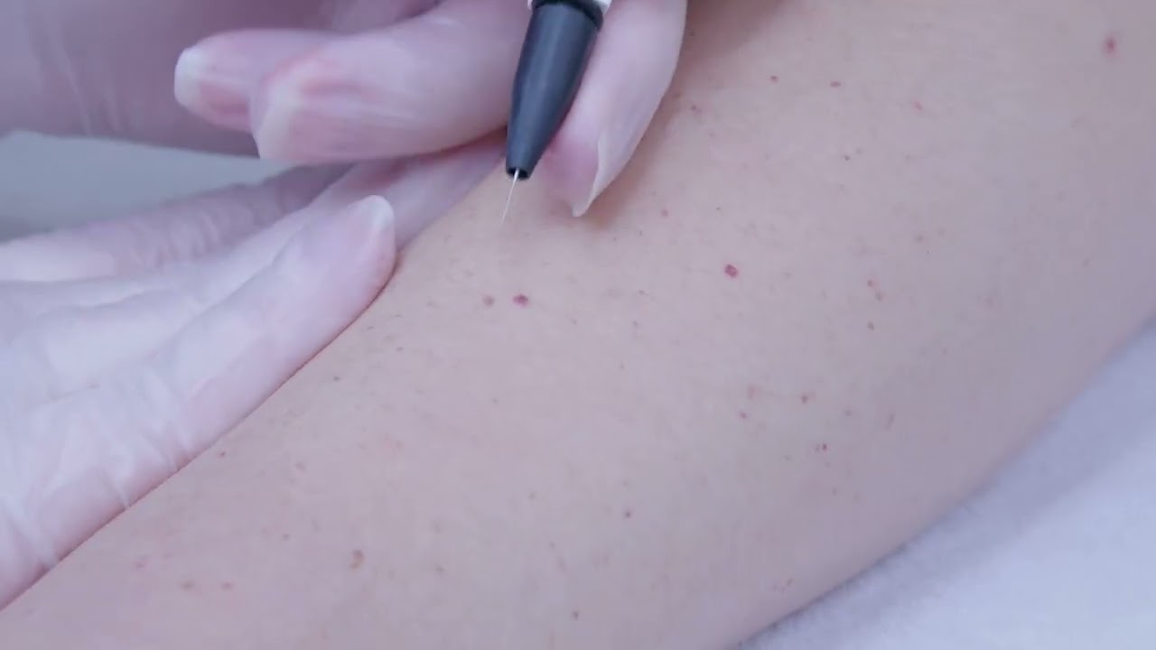Blood Spot Removal | Eden Skin Clinic Treatments