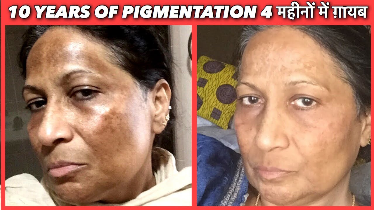 10 years PIGMENTATION gone in 4 months. 60 Years old Anu ji from Arizona