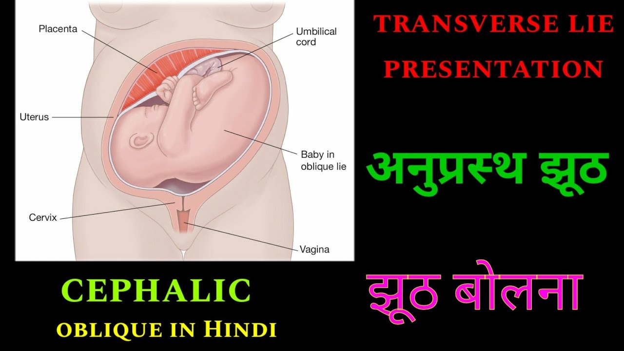 अनुप्रस्थ झूठ / झूठ बोलना/ cephalic oblique lie in Hindi/ transverse lie presentation