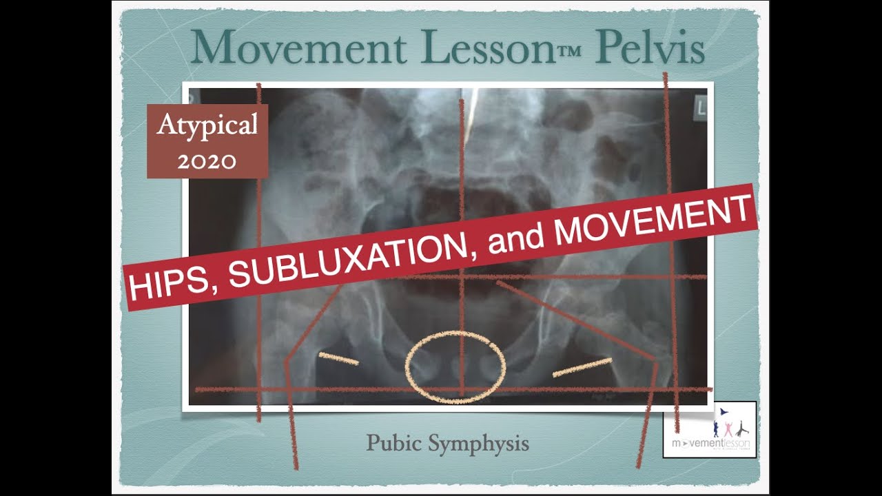 Hips, Subluxation, and Movement