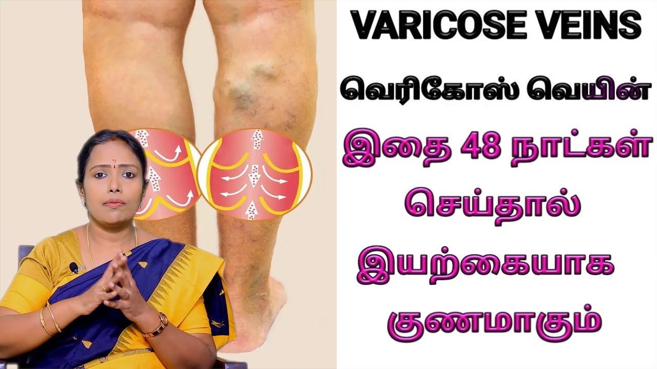 Varicose Veins| வெரிகோஸ் வெயின் குணமாக விளக்கெண்ணெயா? நல்லெண்ணெயா? எதை எப்படி பயன்படுத்தணும்?