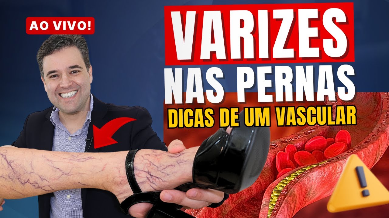 MÁ CIRCULAÇÃO nas PERNAS e PÉS ( secagem e aplicação das varizes, varicose e trombose ) - Dr. Alex