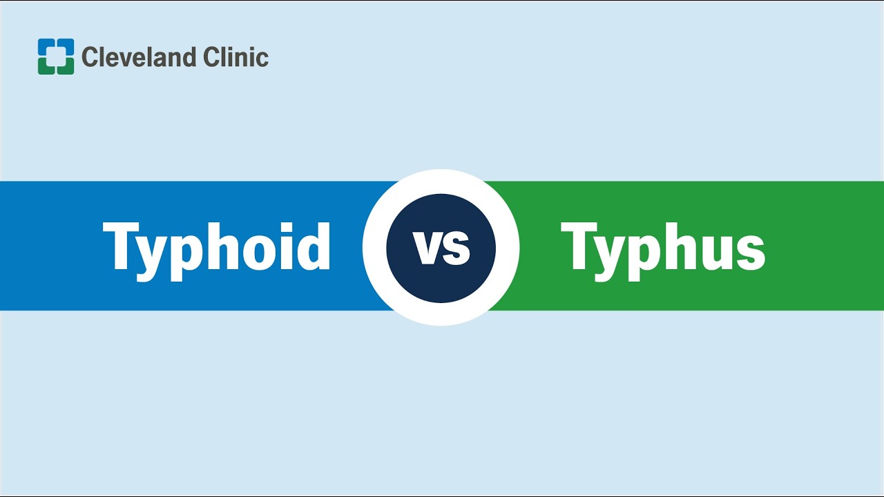 Dur brzuszny a tyfus: jaka jest r&oacute;żnica?