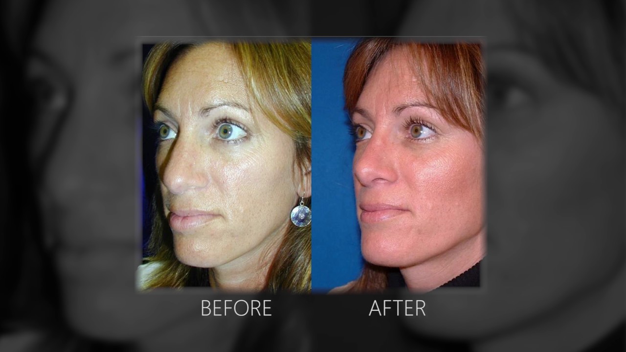 Nose Surgery Rhinoplasty   Summit Plastic Surgery and Dermatology