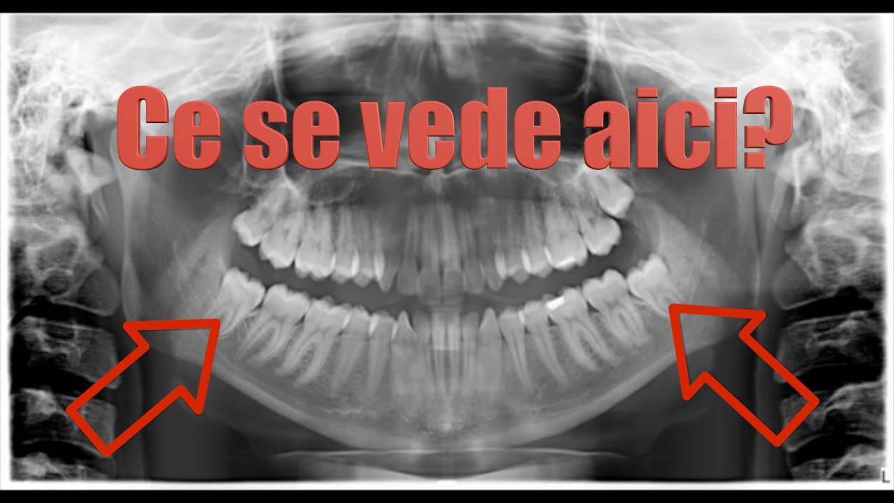 Ce se vede pe RADIOGRAFIA PANORAMICA?