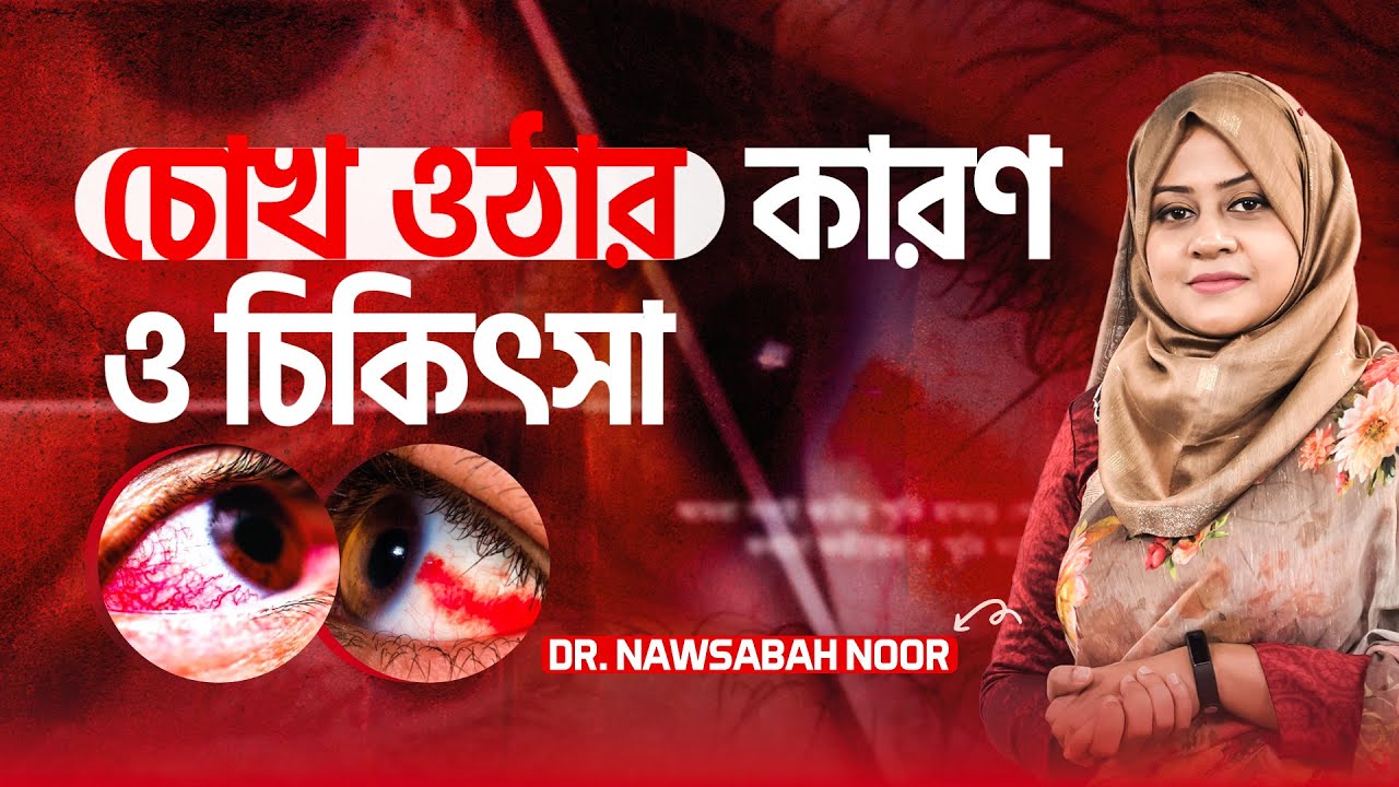 চোখ ওঠার কারণ ও চিকিৎসা | Conjunctivitis