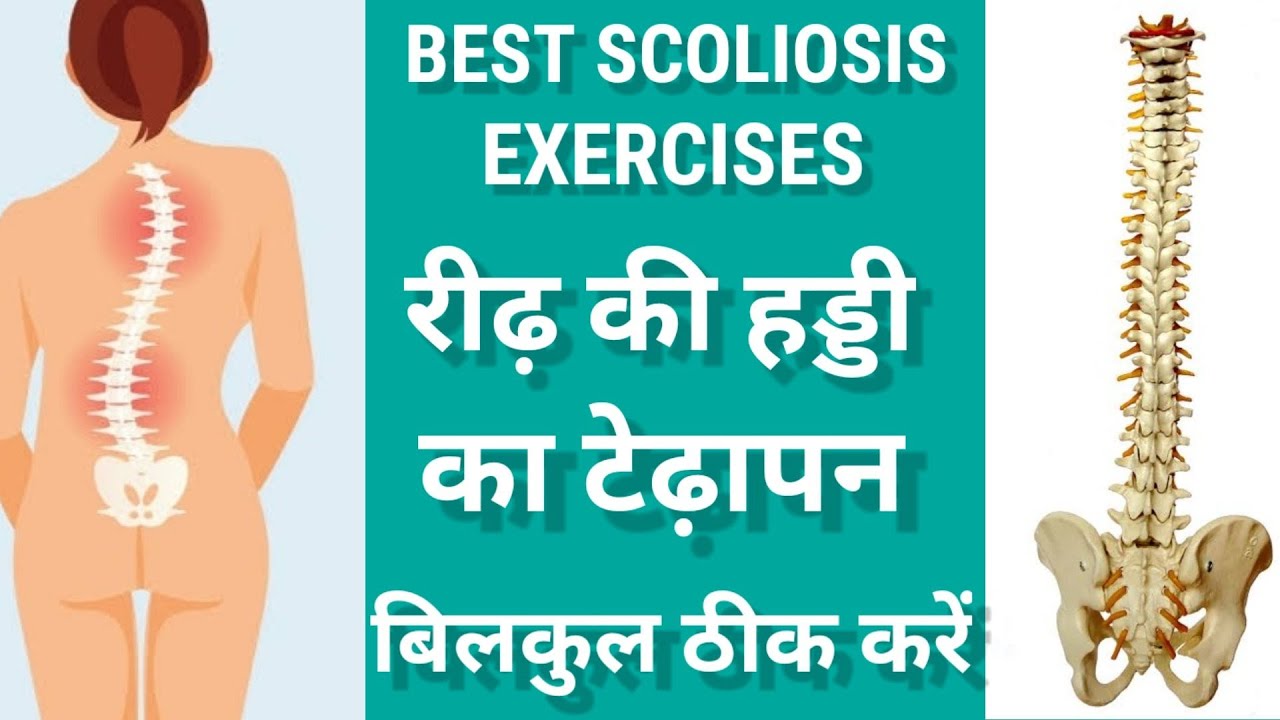 BEST EXERCISES FOR SCOLIOSIS IN HINDI | SCOLIOSIS EXERCISES FOR S AND C CURVE | SCOLIOSIS CORRECTION