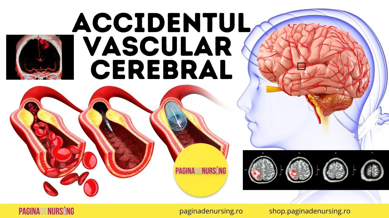 Accidentul vascular cerebral AVC (&Icirc;ngrijirea pacientului cu AVC)