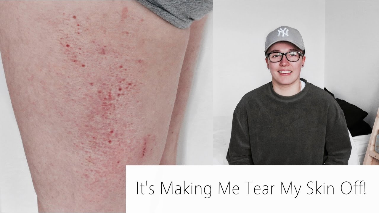 6 Months On Hormone Blockers | FTM Transgender
