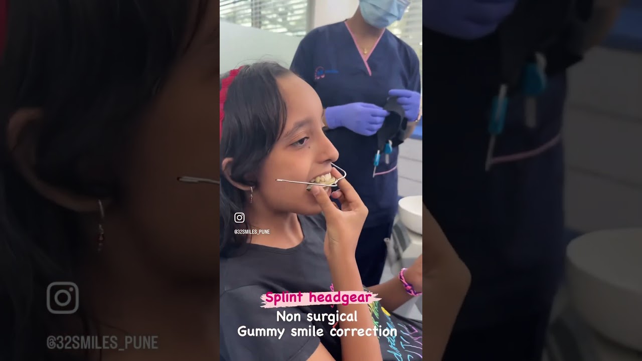 #Splint headgear for gummy smile correction  in growing patients #32smilespune