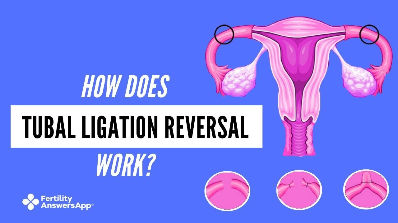 Tubal Ligation Reversal vs. IVF