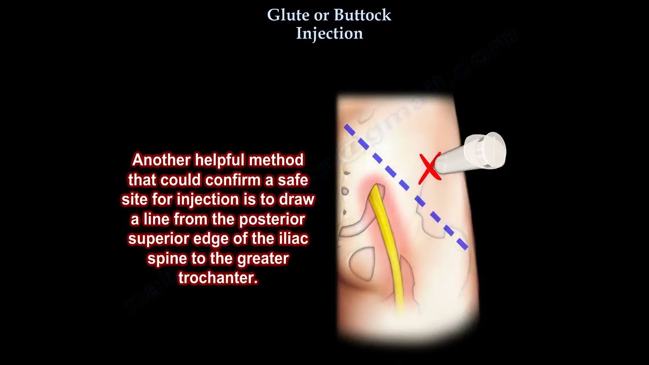 Safe Buttock Injection and Sciatic Nerve Considerations