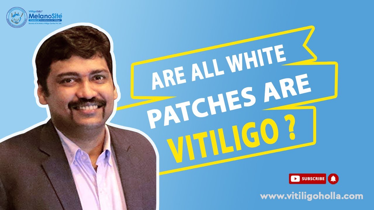 All white patches are not vitiligo - Understanding Vitiligo | Dr. A P Holla | MelanoSite.