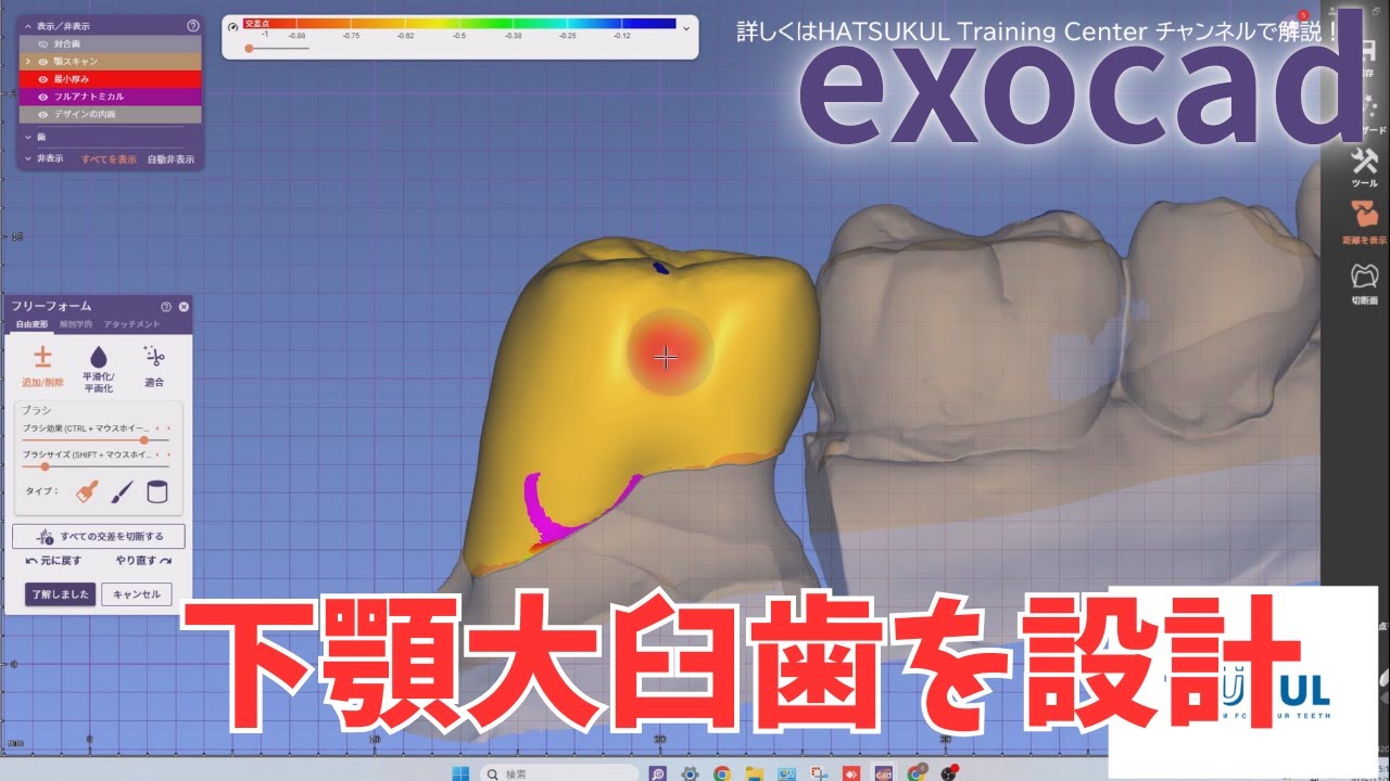#296 　exocad設計　下顎大臼歯を設計（解説なし版）