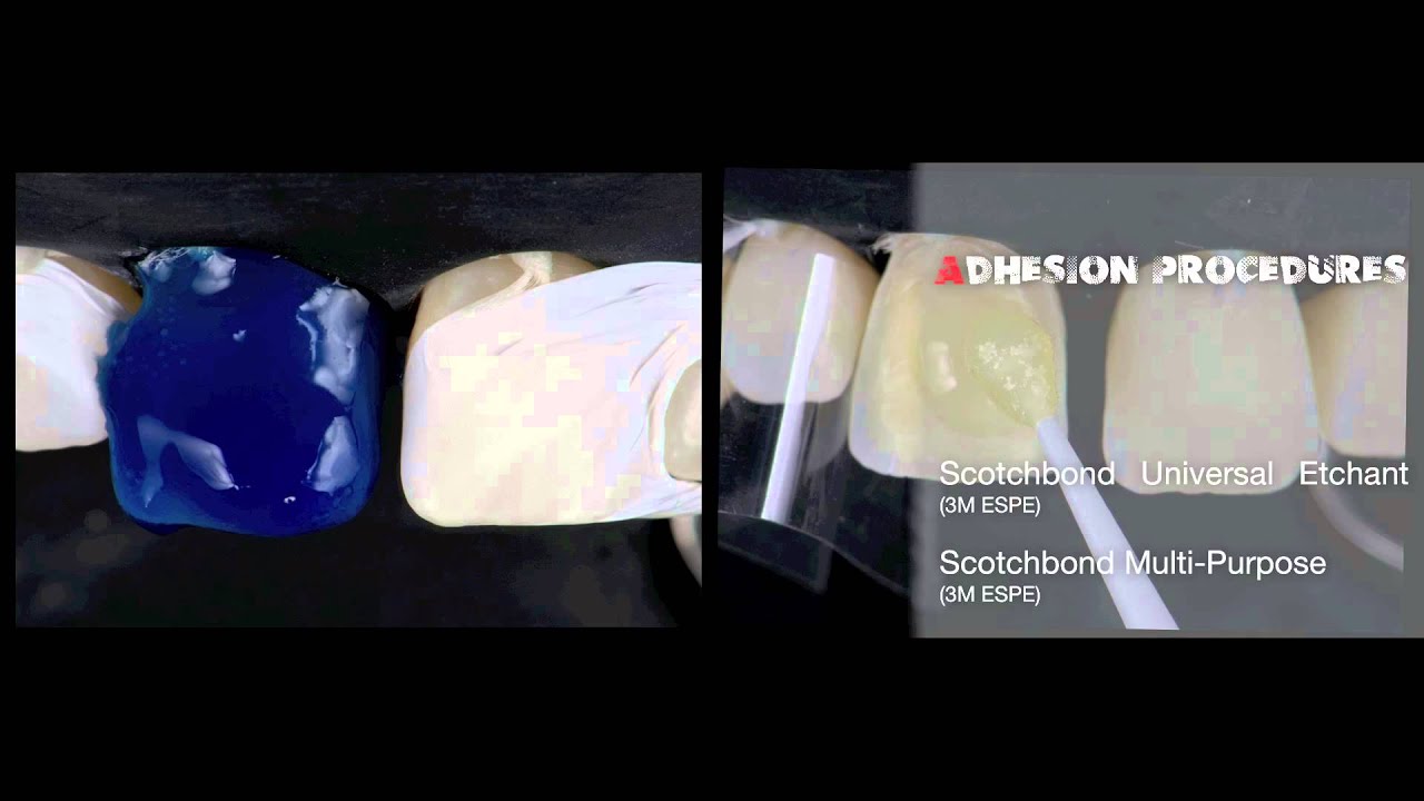 Direct Anterior Composite Resins