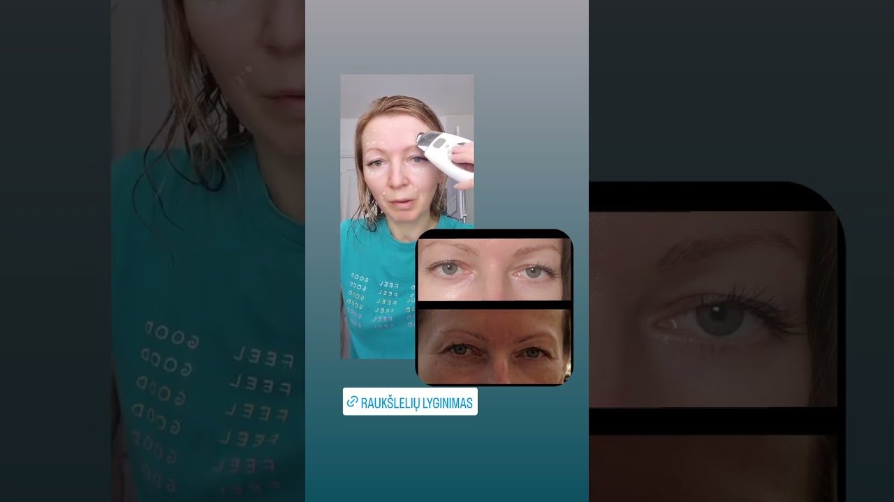 #rauksles#rauksliusvelninimas#grozis#peptiduserumas#spaaparatai