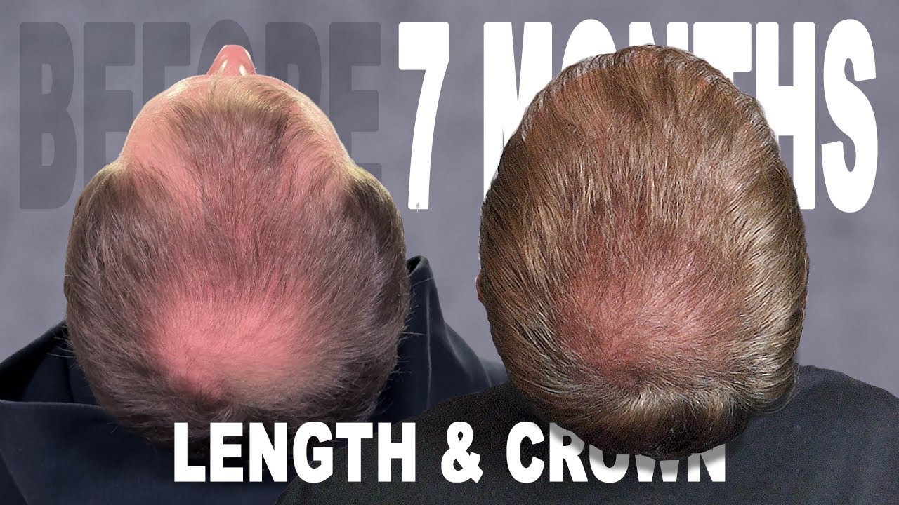 7 MONTHS | HAIR TRANSPLANT | COSMEDICA CLINIC