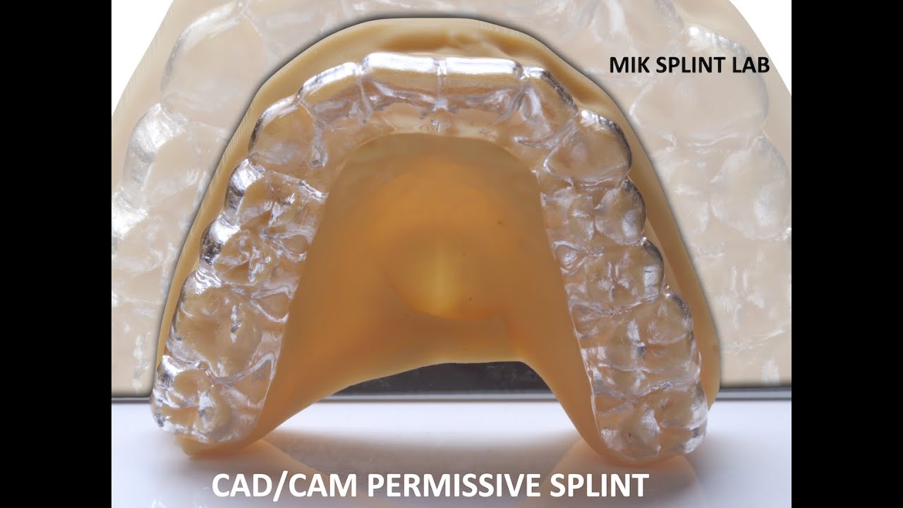 CAD/CAM Permissive Splint by MIK Dental Lab #TMJ #TMD