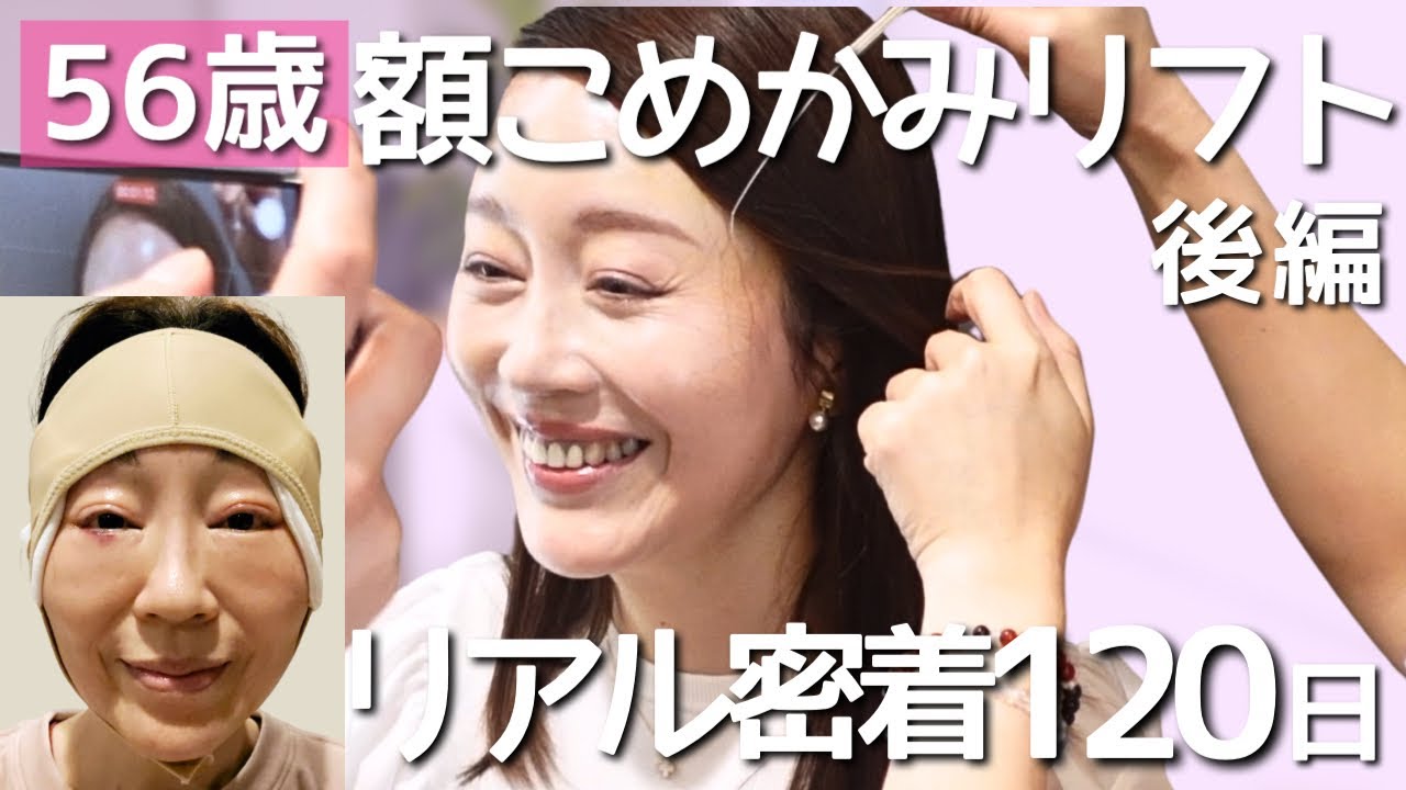 56歳、額こめかみリフト密着ドキュメント【後編】ダウンタイム120日までのリアルな記録
