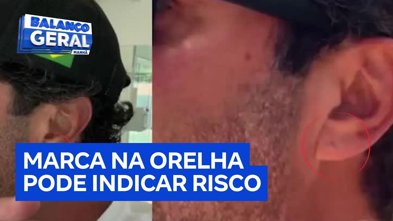 Sinal de Frank: marca na orelha pode indicar risco de infarto e AVC