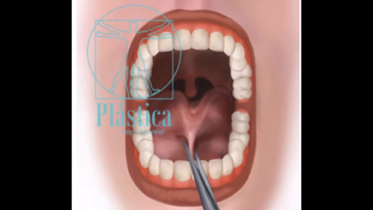 Frenillectomia lingual - Procedimiento Oral - Dra. Sandra Nieto