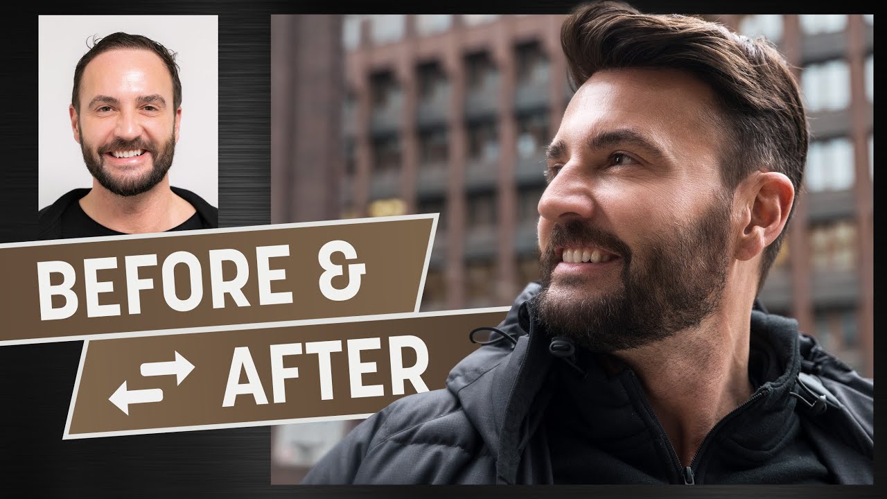 Casual sport hairstyle with a hairsystem | Hair transplant upgrade by Heydecke