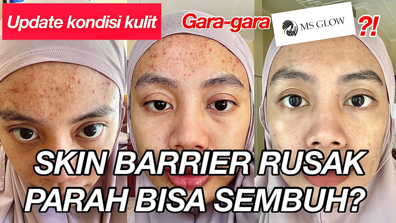 #myexperience | SKIN BARRIER RUSAK PARAH | Pengalaman yang sangat berharga