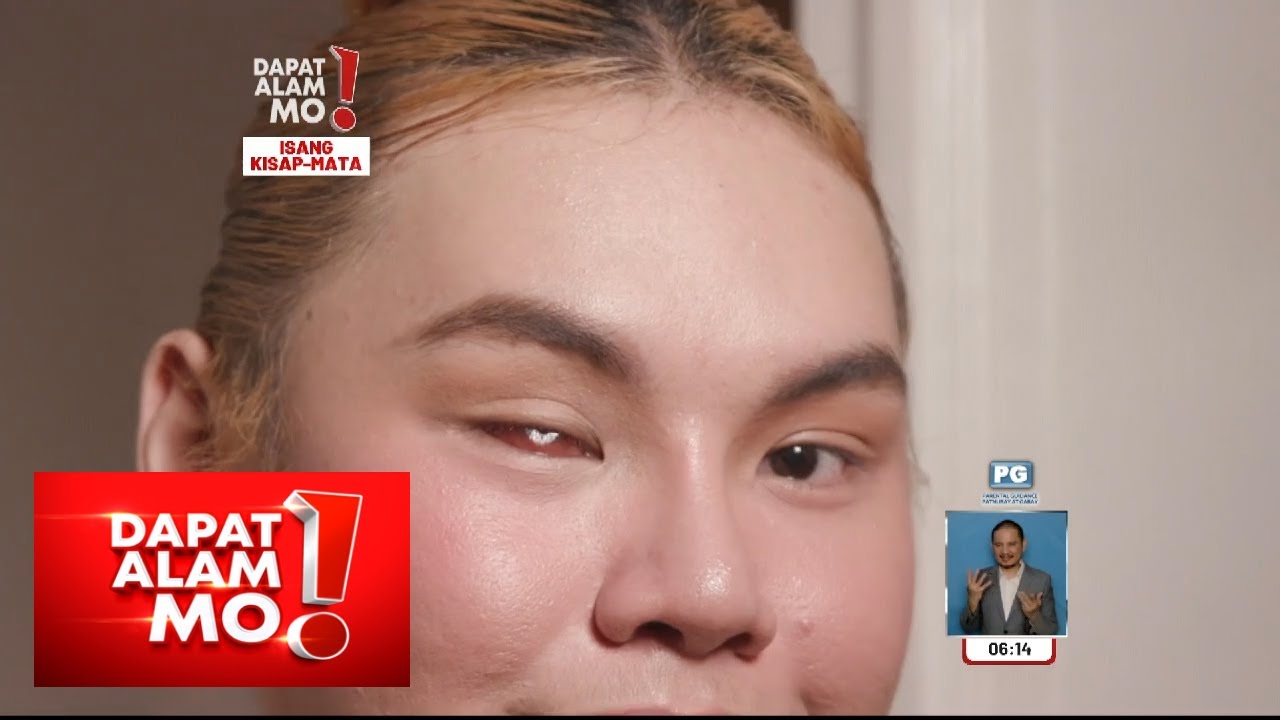 Isang mata ng 22-anyos na content creator, bakit kinailangang tanggalin? | Dapat Alam Mo!