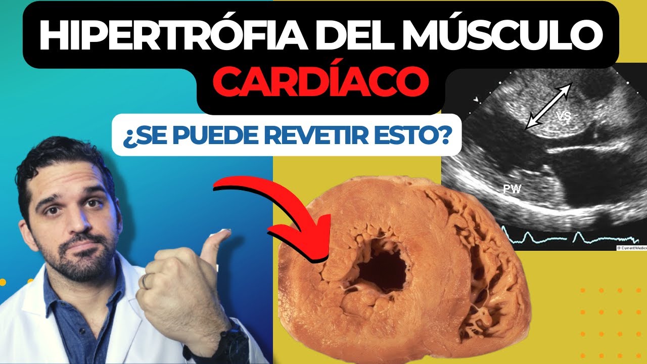 Hipertrofia del corazón. Qué lo CAUSA y como TRATARLO !🤔 ✅