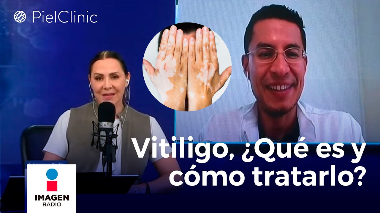 Vitiligo ¿Qué es y cómo tratarlo?
