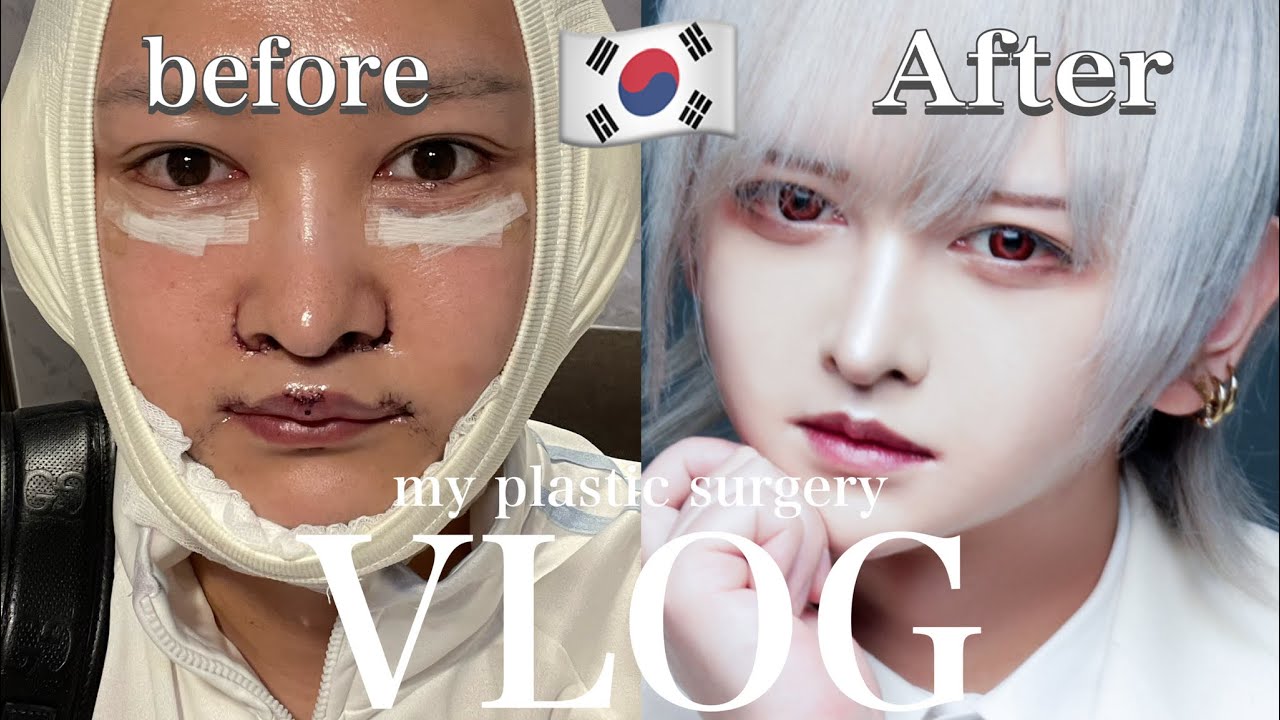 【韓国整形】整形しました！【VLOG】