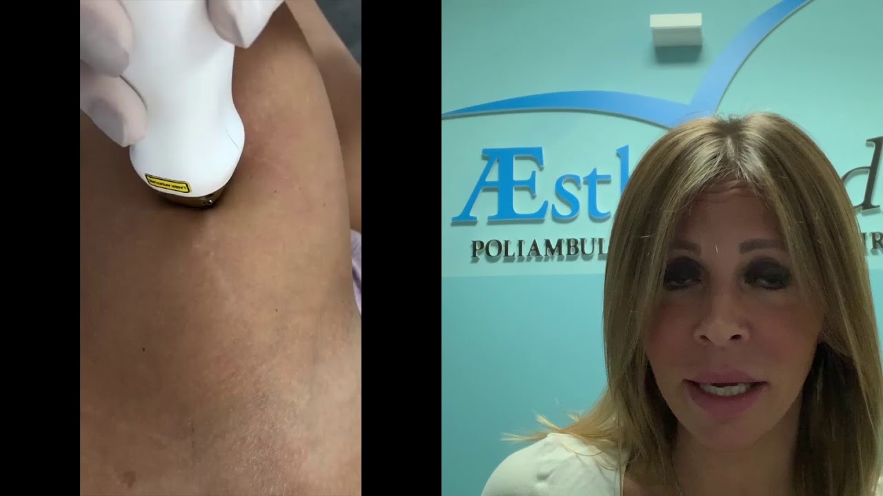 Trattamento Smagliature | Medicina Estetica dott.ssa Laura Mazzotta