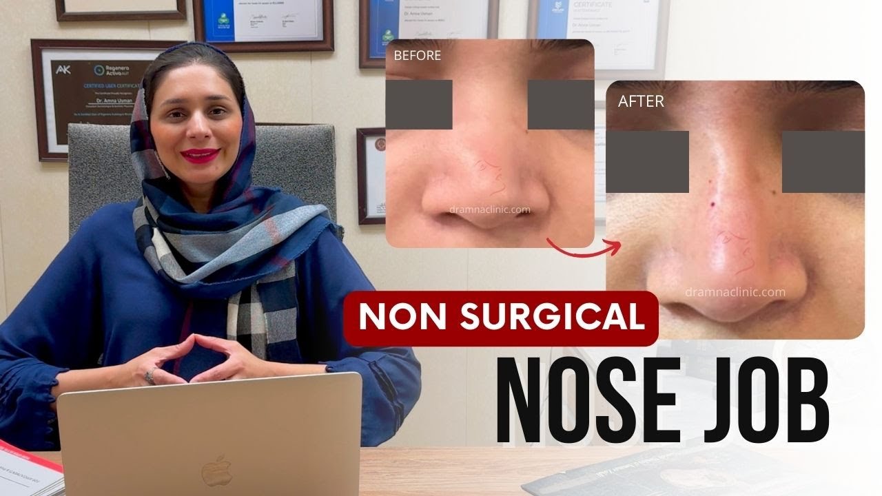 Non-surgical nose job