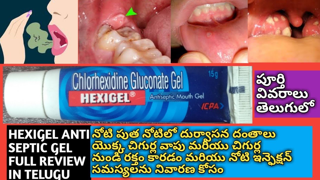 HEXIGEL GEL FULL REVIEW IN TELUGU MEDICINE TO TREAT FOR MOUTH ULCER AND GUM SWELLING AND BAD SMELLS
