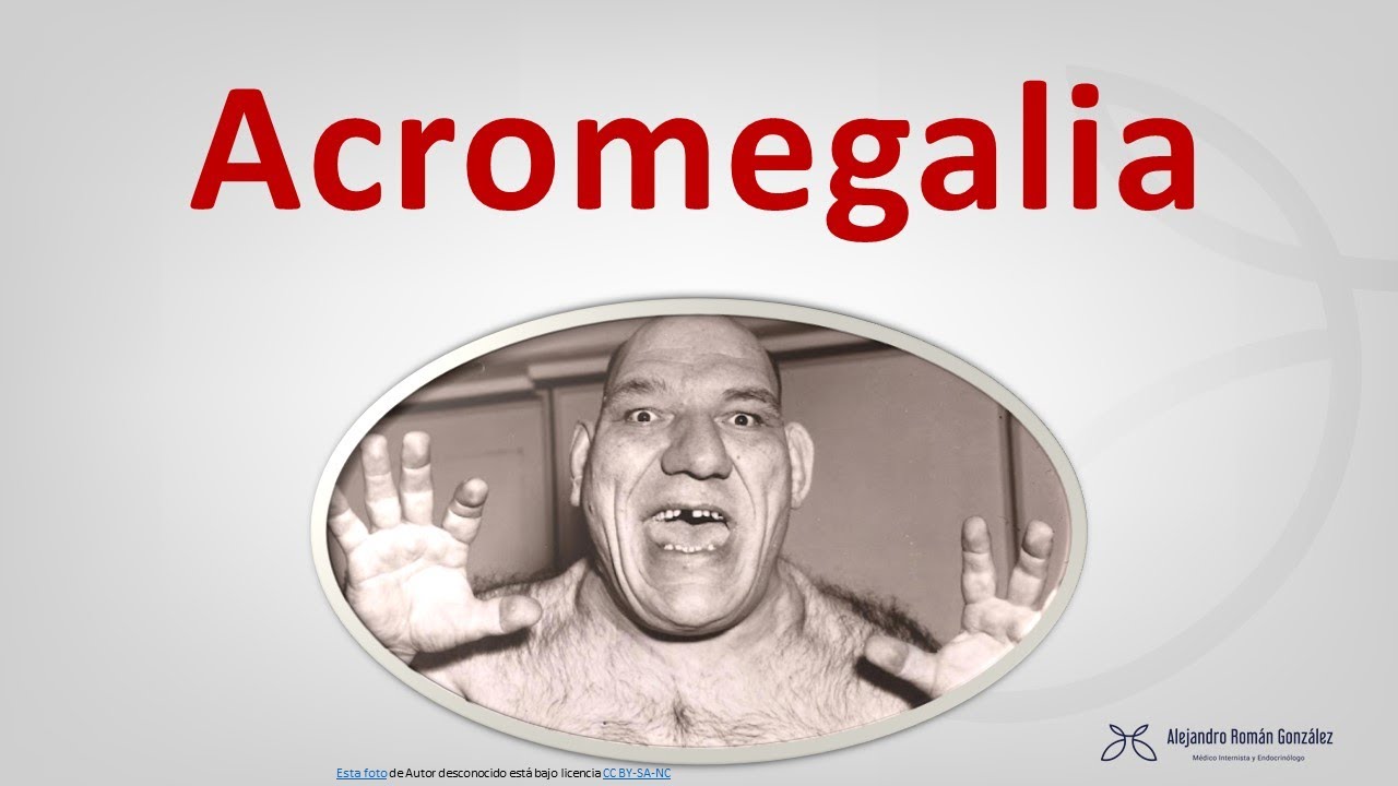 Acromegalia: una enfermedad apasionante. Manifestaciones, diagnóstico y tratamiento